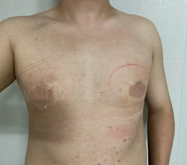 수술 다음 날 아침 사진