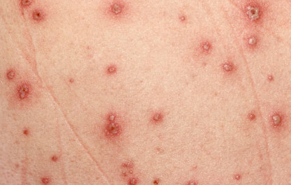 Chickenpox (Varicella) Complete Guide's pic