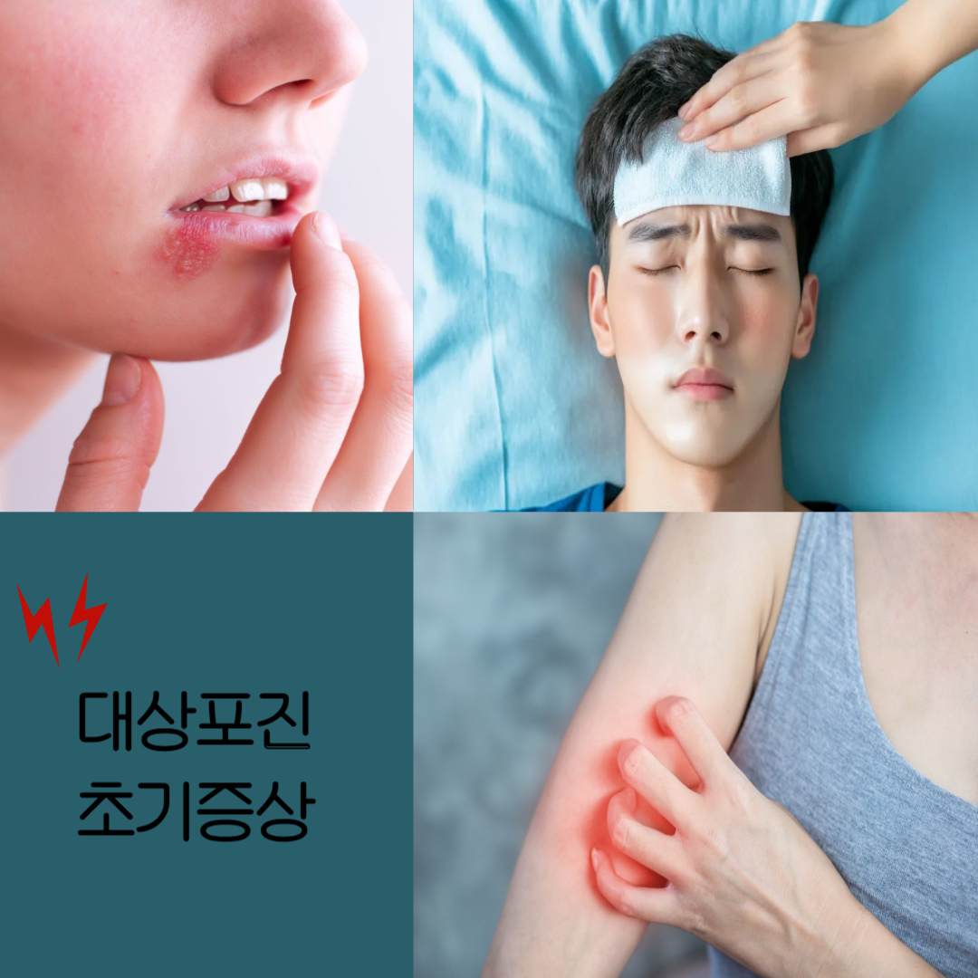 대상포진 초기증상