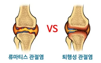 효과적인 류마티스 관절염 치료제 추천 약물 비교 가이드 2025 최신판_13