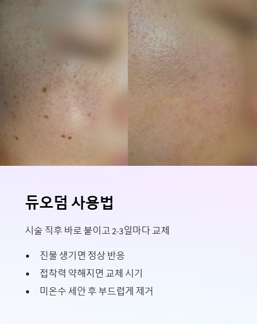 듀오덤 사용법