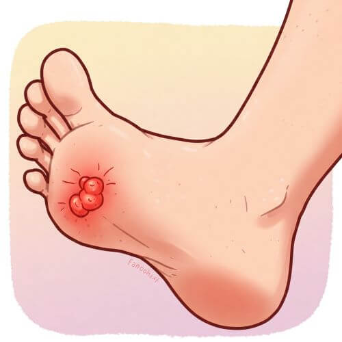 발바닥에 티눈이 생겨 빨갛게 변하고 아파보이는 일러스트