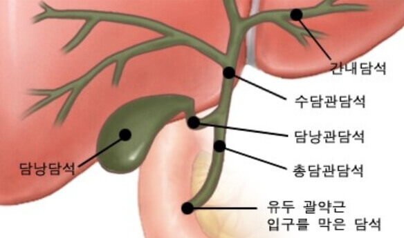 담석 위치