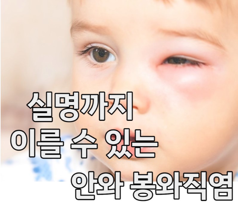 안와염조직염이란?