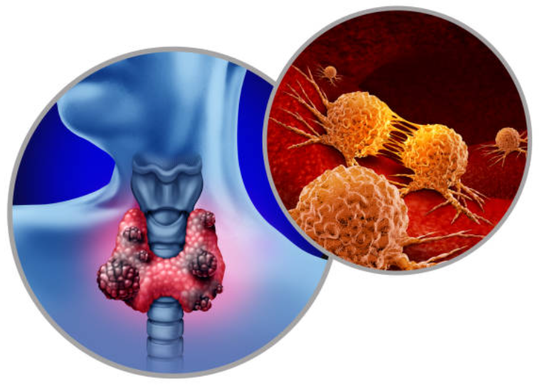 갑상선암과 관련된 사진