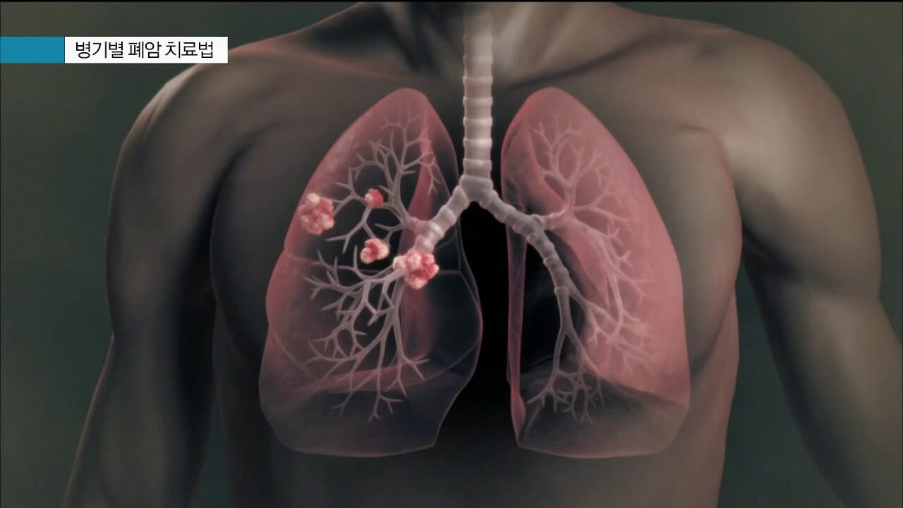 폐암 치료 후 빠른 회복
