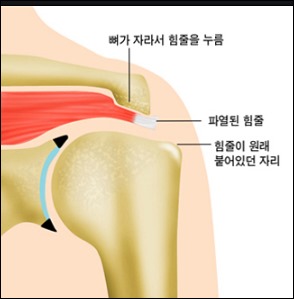 어깨통증 원인 4