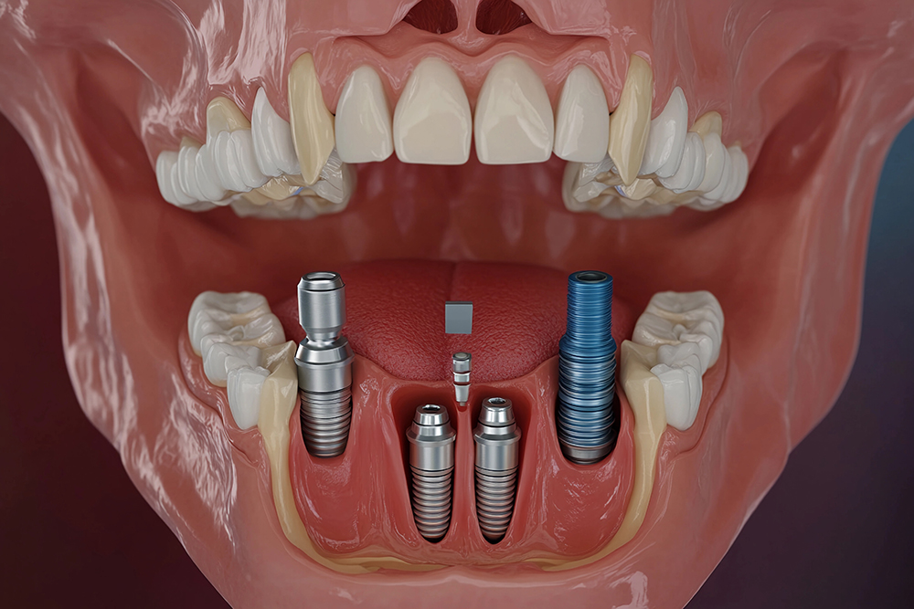 전체 임플란트 가격