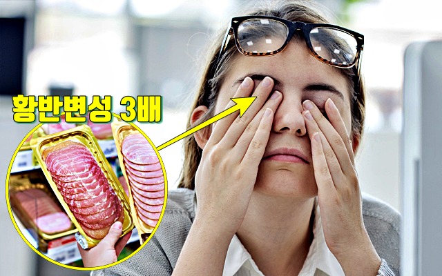 황반변성 증상 원인,눈에 안좋은 음식 햄 소시지 튀김