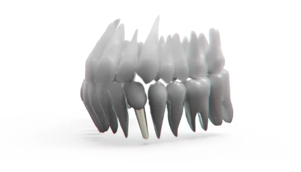 임플란트 시술의 장단점