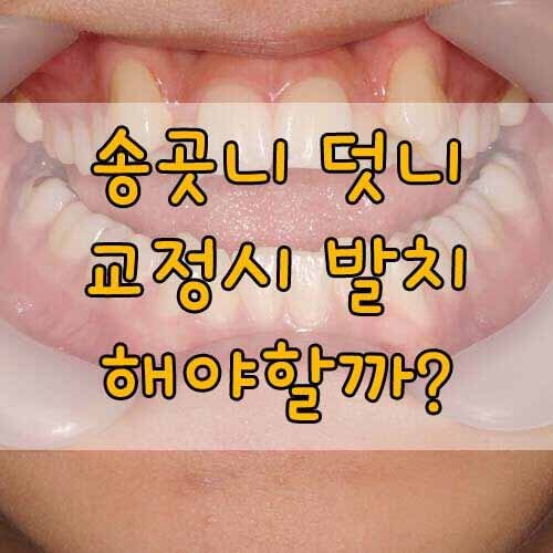 송곳니 덧니, 교정할때 발치 해야 할까?