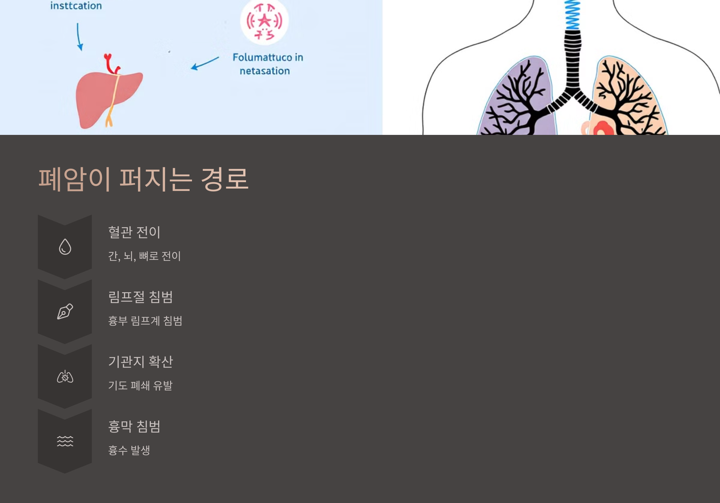 폐암이 퍼지는 경로