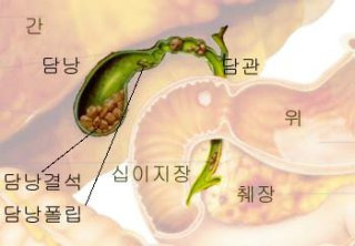 담도암 담낭암 차이