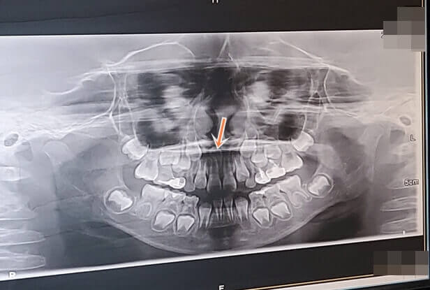 아이 치과엑스레이사진
