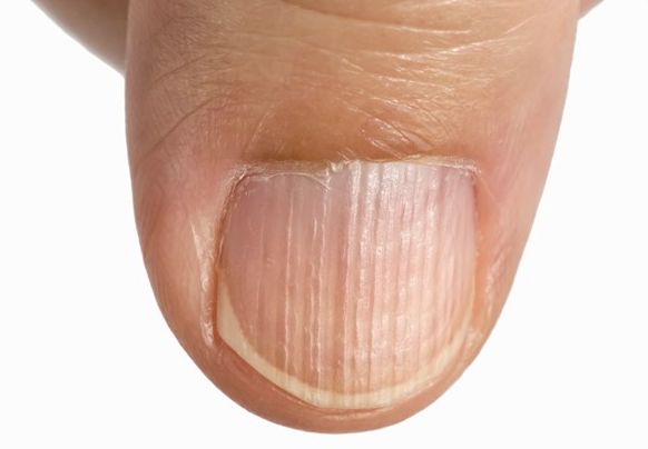 손톱으로 보는 건강상태