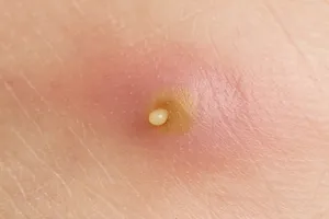 얼굴-비립종-제거