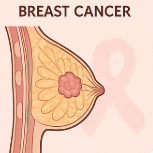 유방암의원인 구분