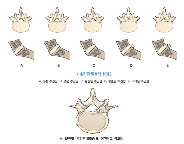 허리디스크 증세