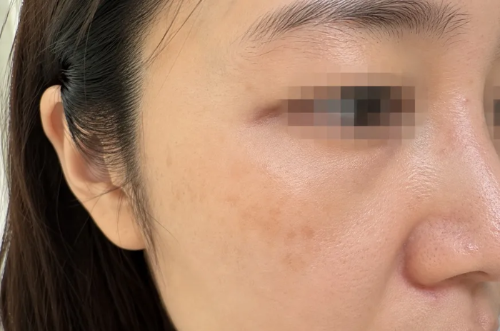 광대와 눈가 주변에 조금 옅어진 갈색 잡티 색소 침착의 실제 피부 상태