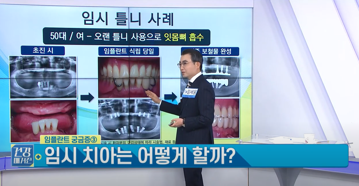 임플란트 틀니, 임시치아를 사용합니다.