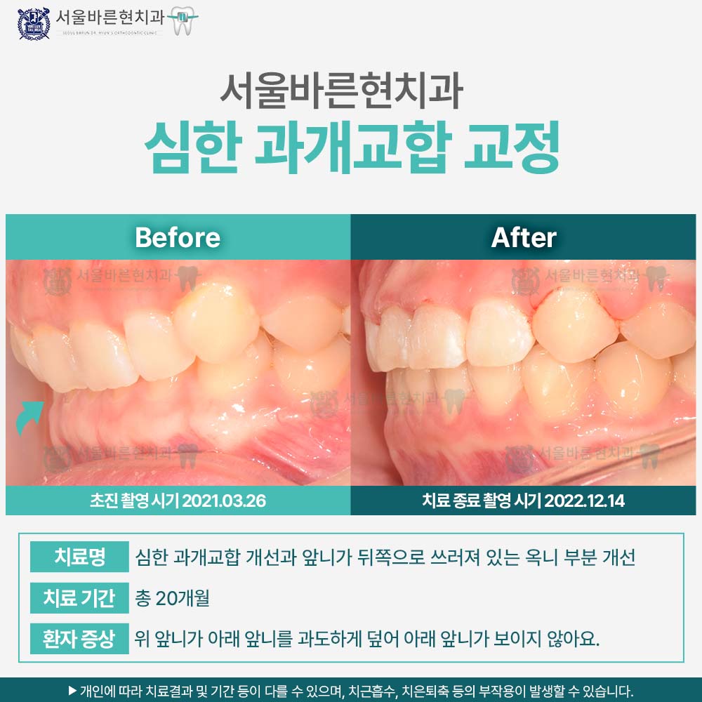 부산치아교정