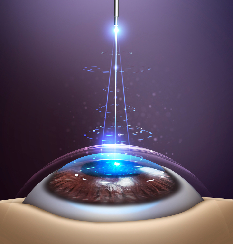 라식과 라섹 차이점 (개인 경험담)