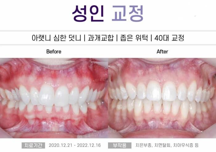 치아 부정교합 치료모습