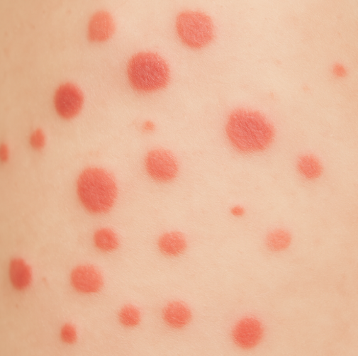 몸에 붉은 반점 원인
