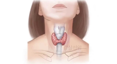 갑상선 이미지