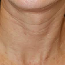 목주름 없애는 비결