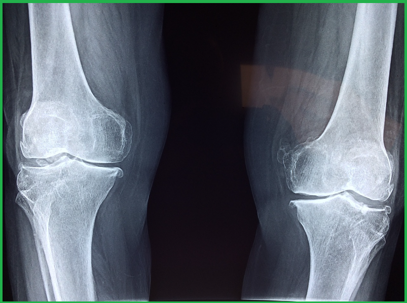 무릎통증-예방-치료