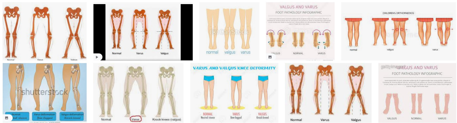 의학용어 valgus 뜻 가쪽휜, 외반 varus 뜻 안쪽휜, 내반