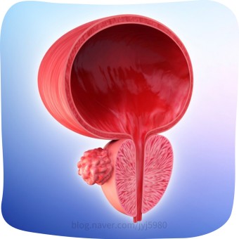 전립선암 초기증상 