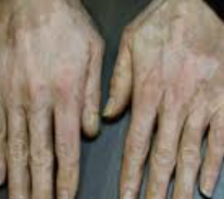 백반증 초기증상 14