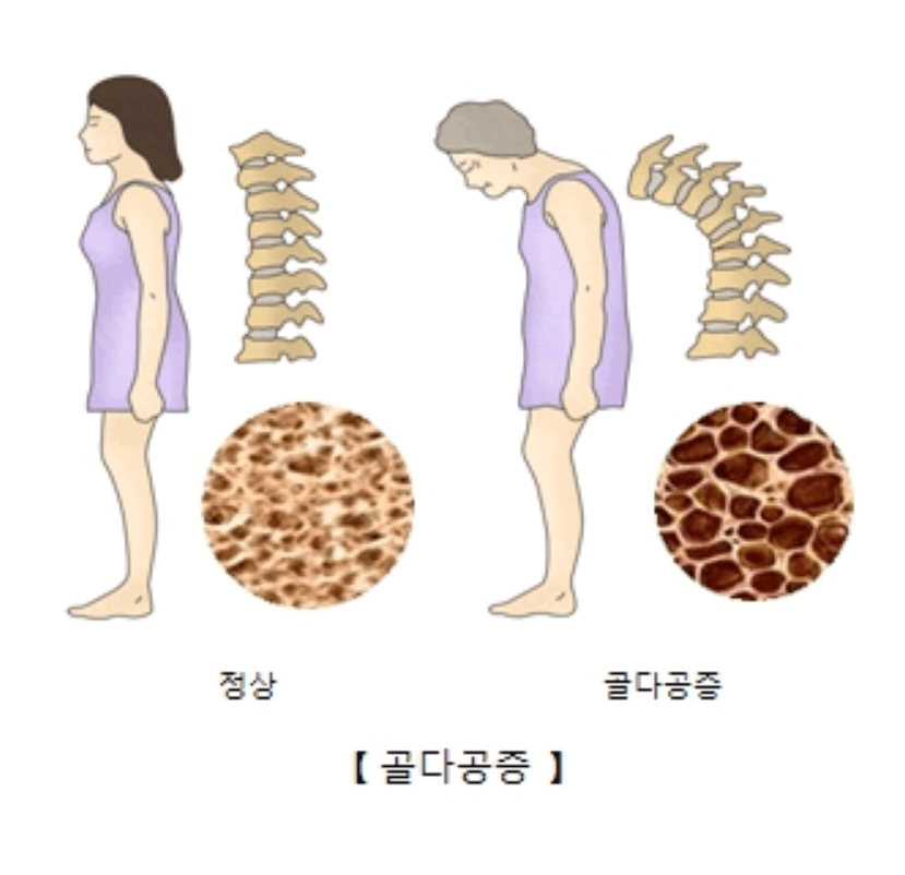 정상인과-골다공증-발생으로-척추-허리-뼈-휘어진-중년-여성