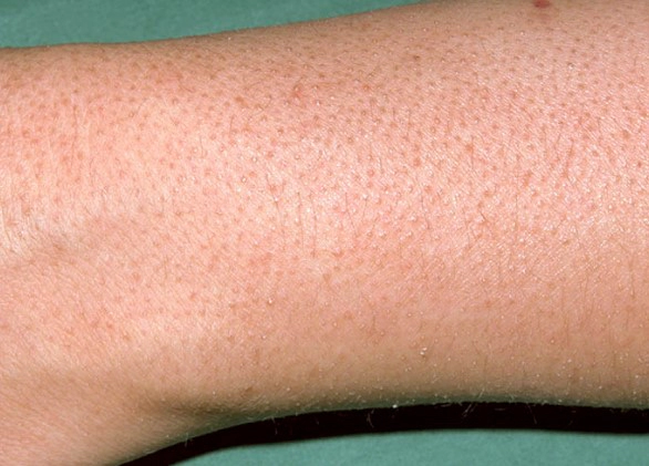 모공각화증 치료 방법 7가지