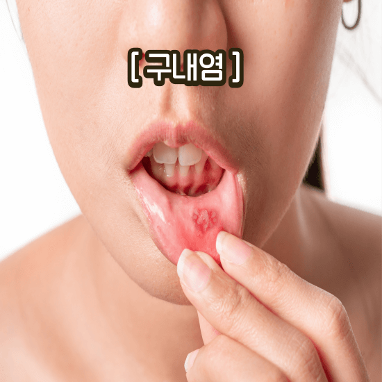 혓바늘 구내염 없애는 법