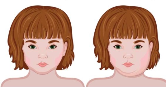 이하선염에 감염되어 볼이 부은 모습의 일러스트