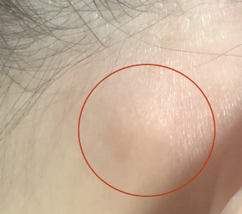 임파선염 증상 27