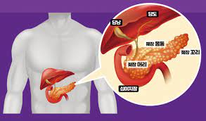 췌장암 의심 증상 여섯가지 발생원인 초기 의심 증상 검사방법 예방법