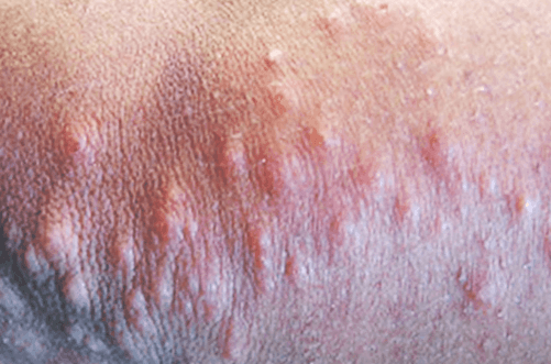 빈대 물린 자국 사진 및 증상