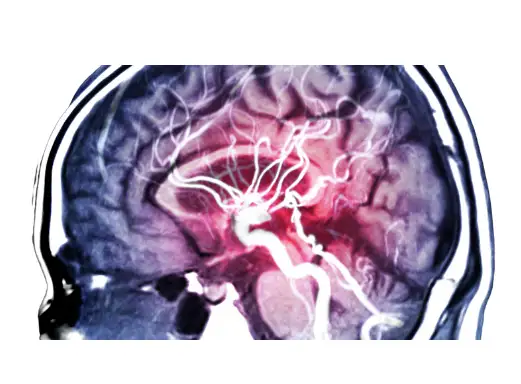 뇌경색 초기증상&amp;#44; 원인 및 치료 방법