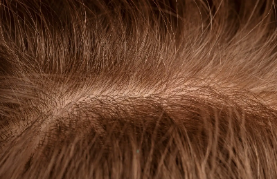 탈모 예방 및 치료