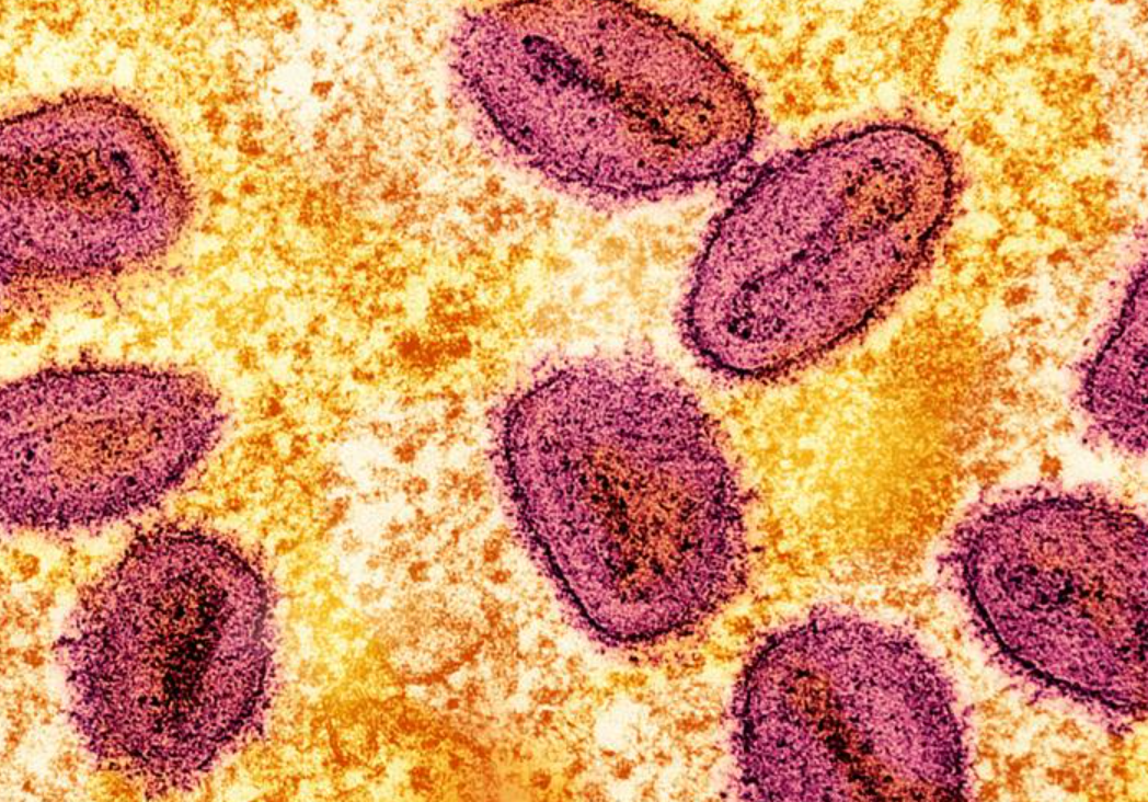 엠폭스 증상 감염경로