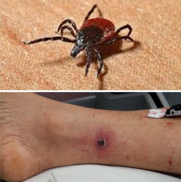 쯔쯔가무시-털진드기병-증상-예방방법-치료방법-안내