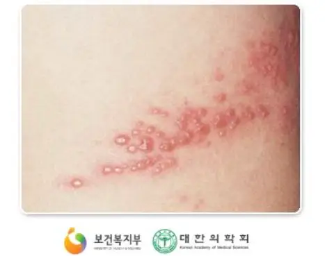 65세 이상 대상포진 예방접종 무료 혜택｜신청 방법과 주의사항