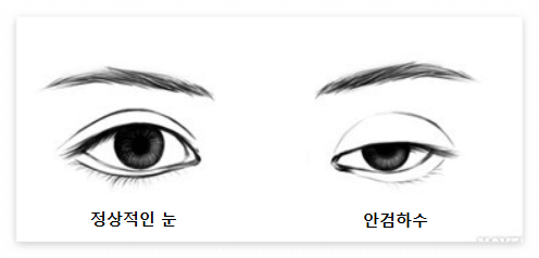 안검하수 원인과 증상
