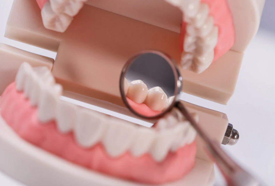 치과치료를 받고 있는 치아 모형