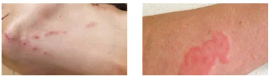 빈대 물린 증상