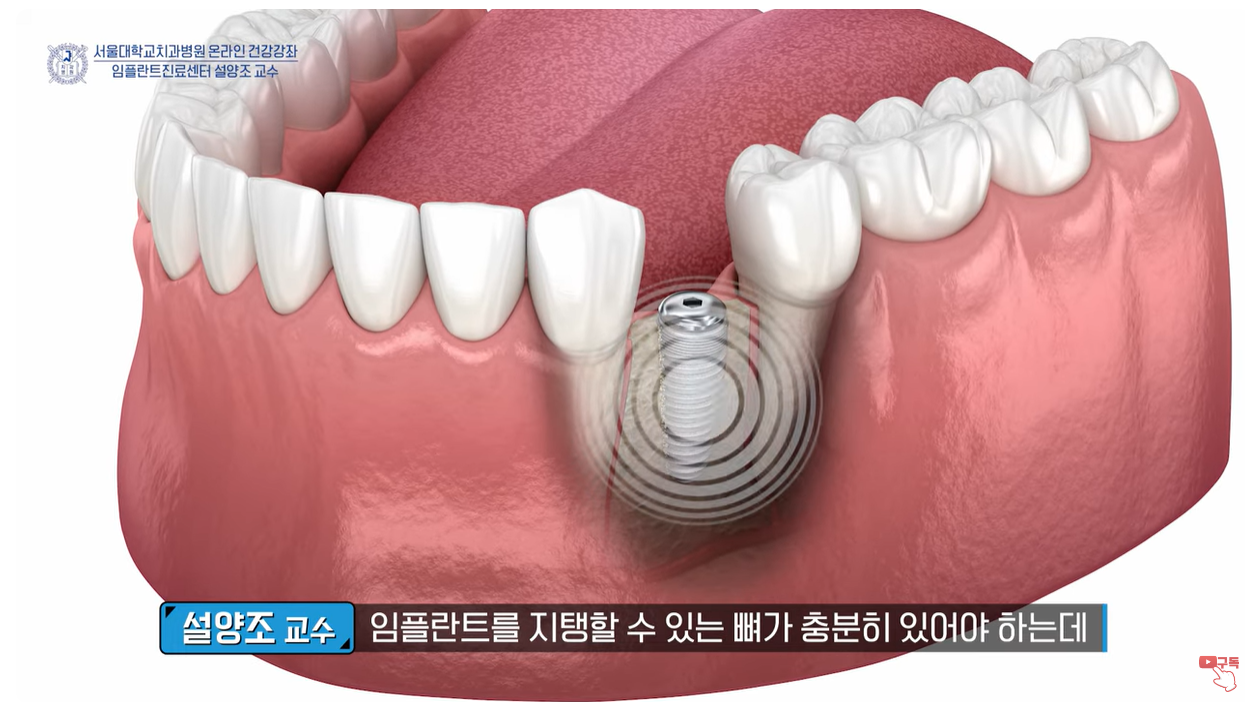 임플란트를 지탱할 수 있는 뼈가 충분한지 미리 확인합니다.